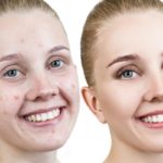 How-to-Get-Rid-of-Acne-Overnight-12-Remedies-that-Work.jpg