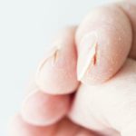 Severely-Cracked-Hands-8-Tips-Remedies-for-Fast-Relief.jpg