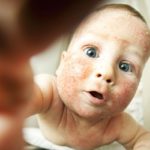 7-eczema-remedies-that-work-slider.jpg